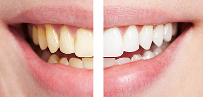 weißere Zähne durch Bleaching