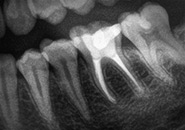 Wurzelkanalbehandlung bei stark vorgeschädigten Zähnen zur Zahnerhaltung